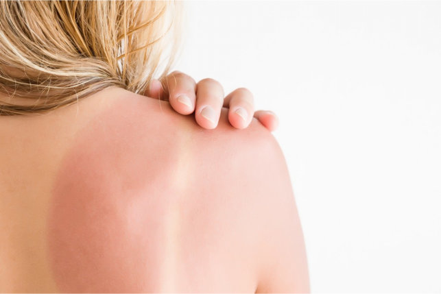 The Common Sunburn and When to Get Help